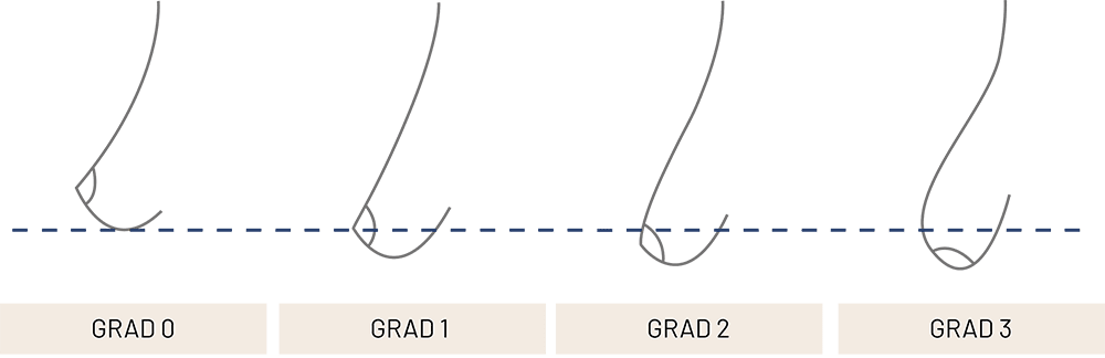 Haengebrustgrad Haengebrustgrad